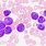 Acute Myeloid Leukemia Blood Smear