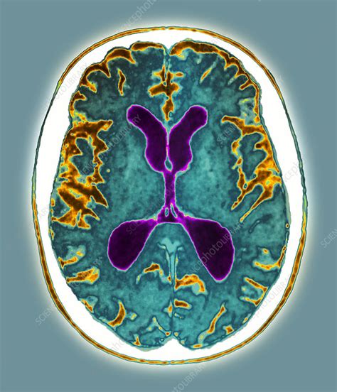 Alzheimer MRI