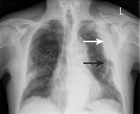 Apical Nodular