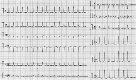 12 Lead EKG