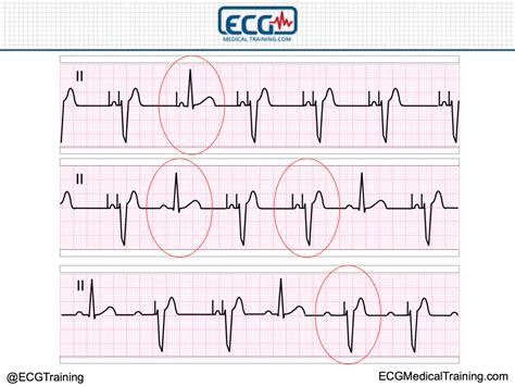 vs Ventricular Paced