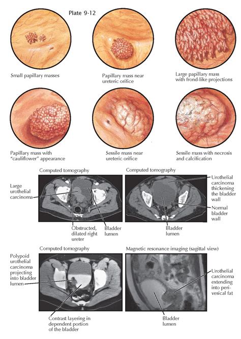 Bladder Tumor Size Chart