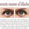 Blindness Symptoms