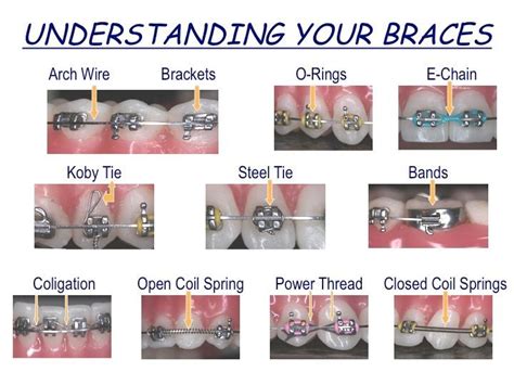 Braces Wire Thickness Chart