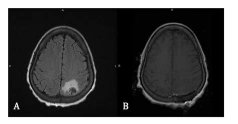 Brain Tumor