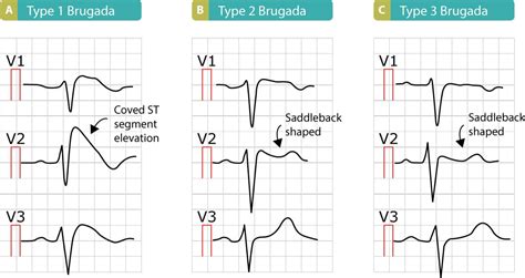 Syndrome ECG Findings