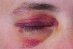 Bruised Eye Ball
