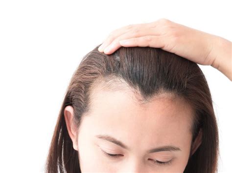 Cara mengatasi garis rambut berkeringat