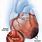 Cardiac Infarction