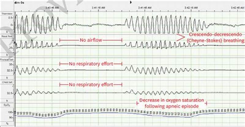 Cheyne Stokes Pattern
