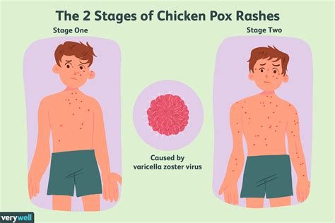 Chickenpox Transmission