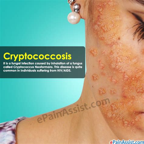 Cryptococcosis Cutaneous Symptoms
