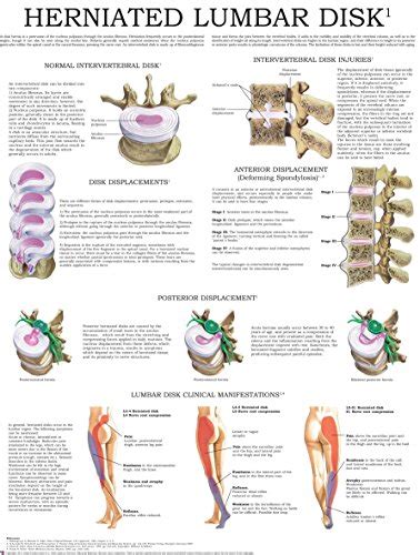 Disc Herniation Size Chart