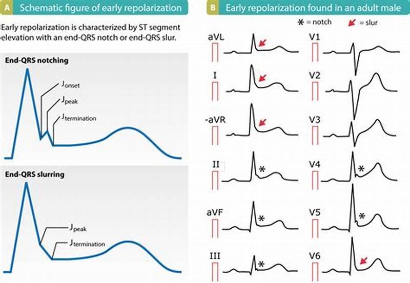Early Repolarization Pattern