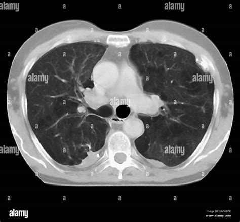 CT Scan