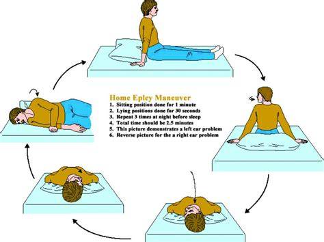 Epley Maneuver At Home Printable