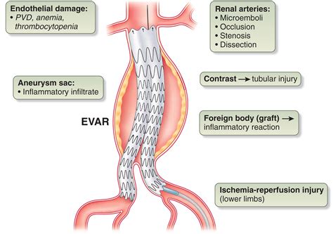 Procedure AAA