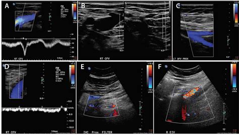 External Iliac