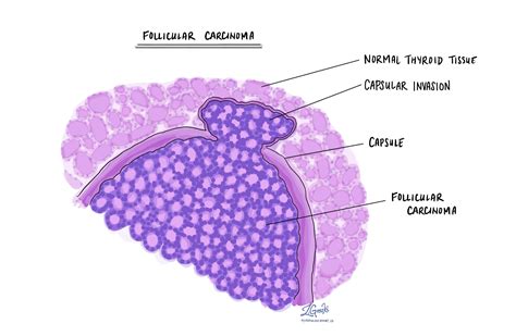 Follicular Thyroid Cancer