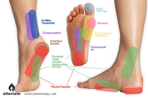 Heel Pain Location Chart
