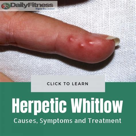 Herpetic Whitlow