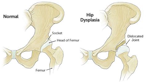 Hip dysplasia