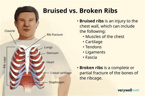 How To Care For Broken Ribs