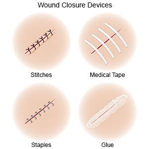 How To Care For Stitches