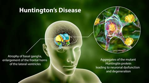 Huntington's Disease