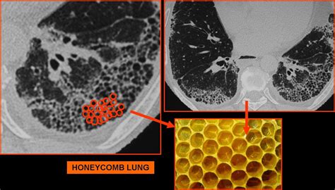 Honeycomb Lung