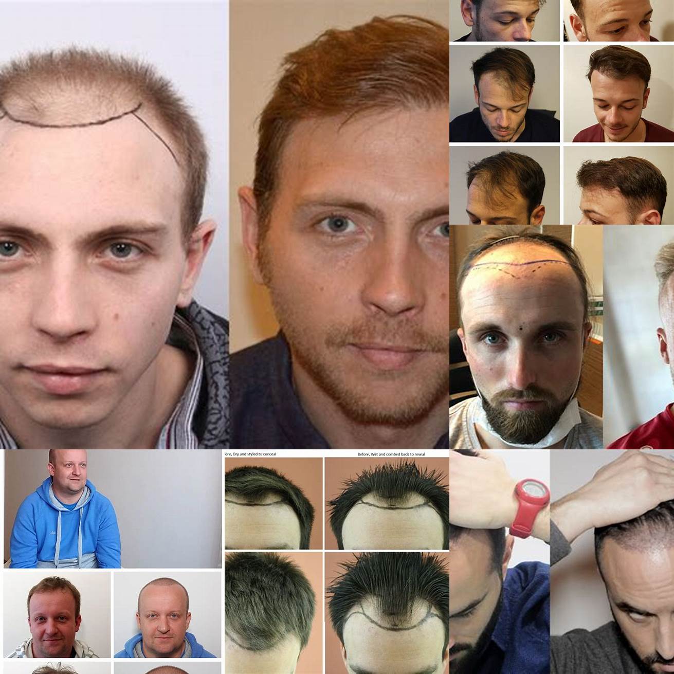 Image dune personne avant et après une greffe de cheveux