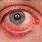 Inflamed Eyes