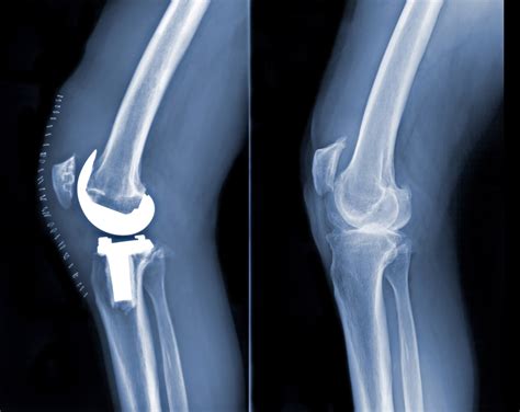 Joint Replacement Surgery for Osteoarthritis