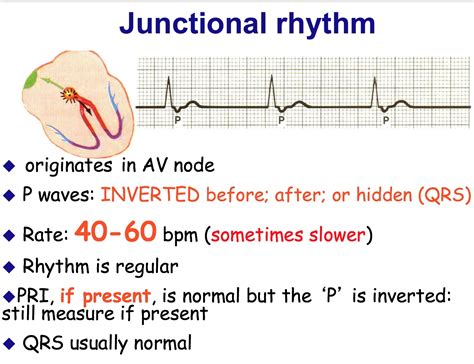 Junctional Rhythm