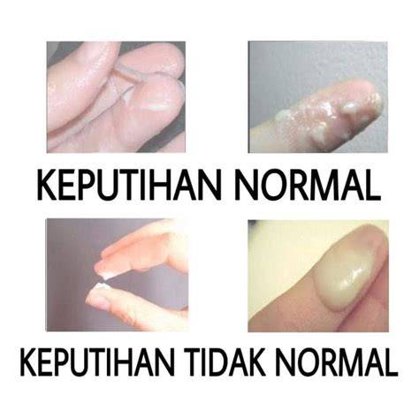 Keputihan Tidak Normal