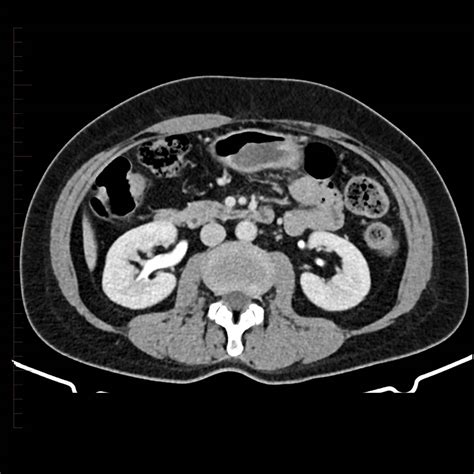 Kidney CT