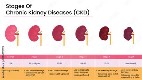 Kidney Disease Stages Chart