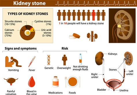Kidney Stone Pain Chart