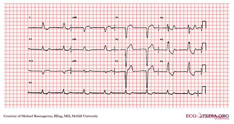 Left Bundle Branch Block