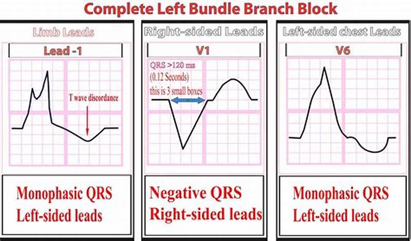 Left Bundle Branch Block Ecg Pattern