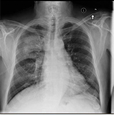 CXR