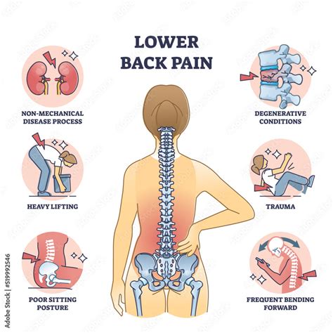 Lower Back Pain Chart