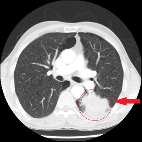 Lung Cancer CT