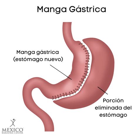 Manga Gastrica Bogota acid reflux