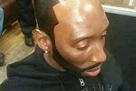 Messed Up Hairline