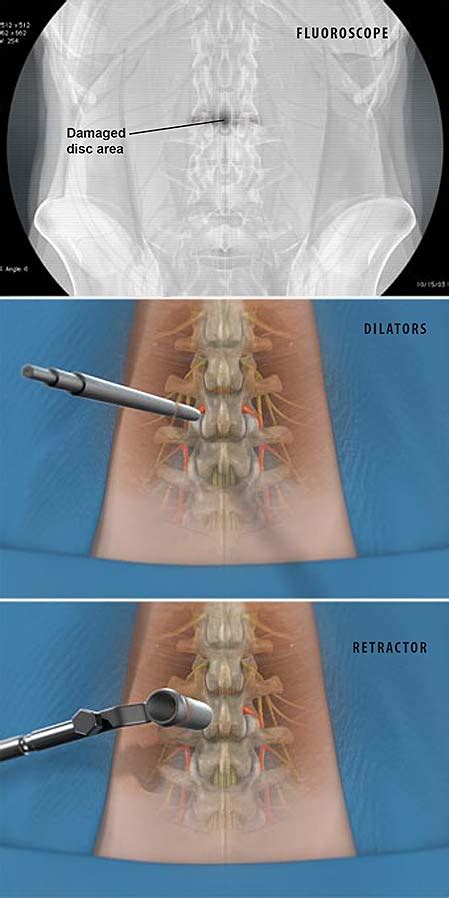 Invasive Spinal Fusion