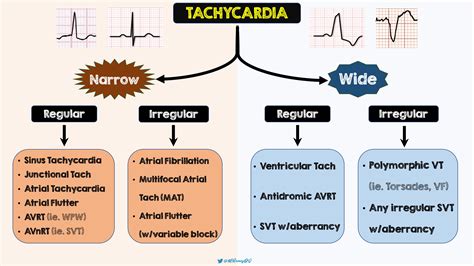 Tachycardia Ddx