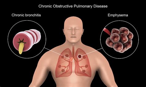 Obstructive Lung Disease