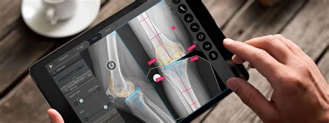 Orthopedic Templating Software
