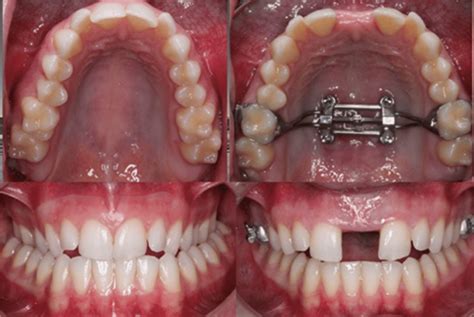 Palatal Expander for Uneven Jaw
